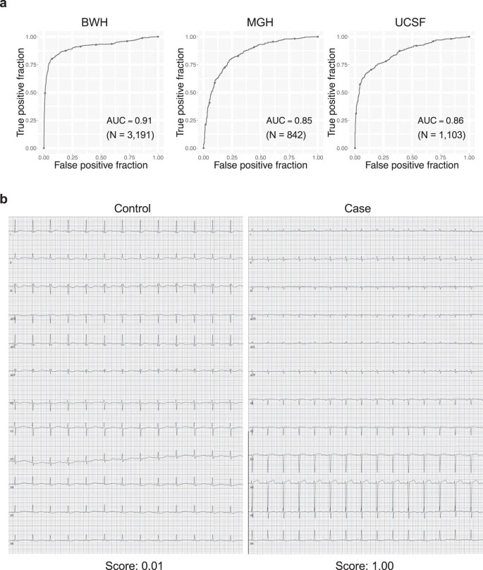 Using artificial intelligence to detect cardiac amyloidosis